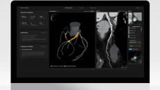 Salix Coronary Anatomy by Artrya