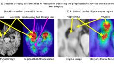 Detailed atrophy patterns that AI focused on predicting the progression to Alzheimer's disease 